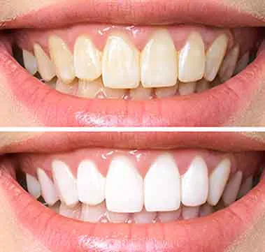 Antes e depois clareamento dental — Instituto Paskakulis