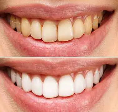 Resultado clareamento dental Jundiaí — Instituto Paskakulis
