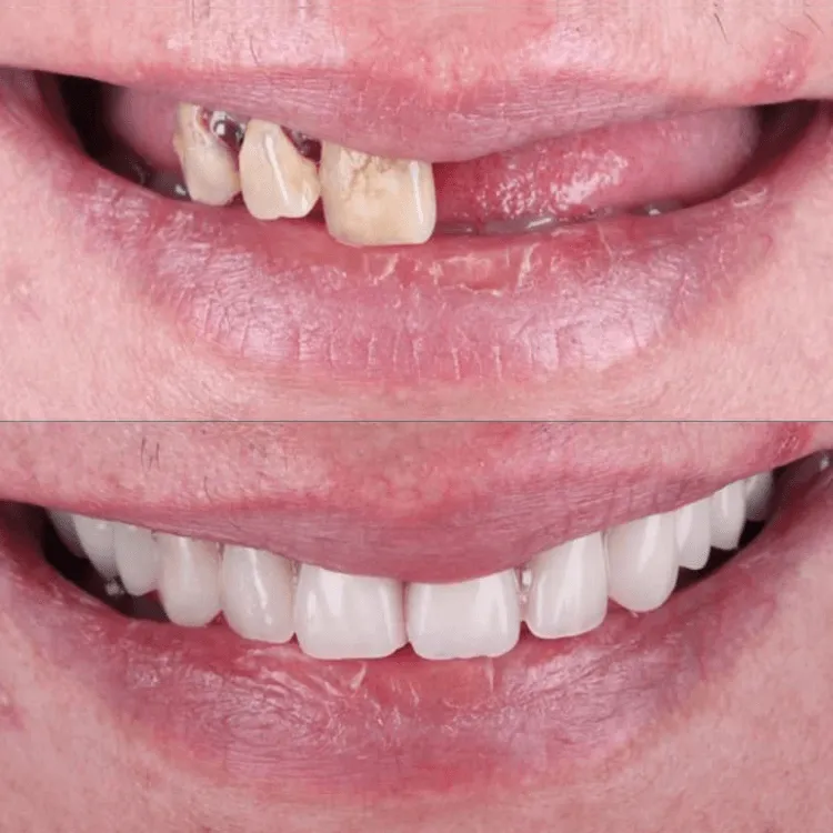 Implante dentário resultado natural — Instituto Paskakulis