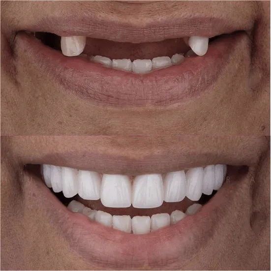 Resultado implante dentário Jundiaí — Instituto Paskakulis