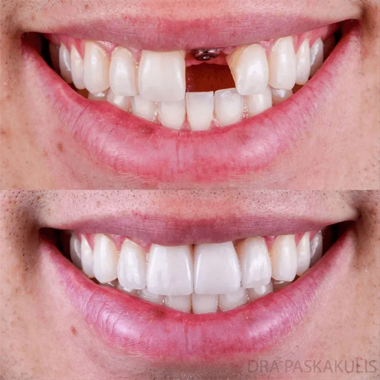 Antes e depois implante dentário — Instituto Paskakulis Jundiaí