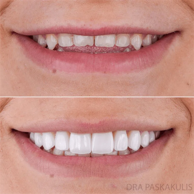 Sorriso transformado com lentes de contato — Instituto Paskakulis