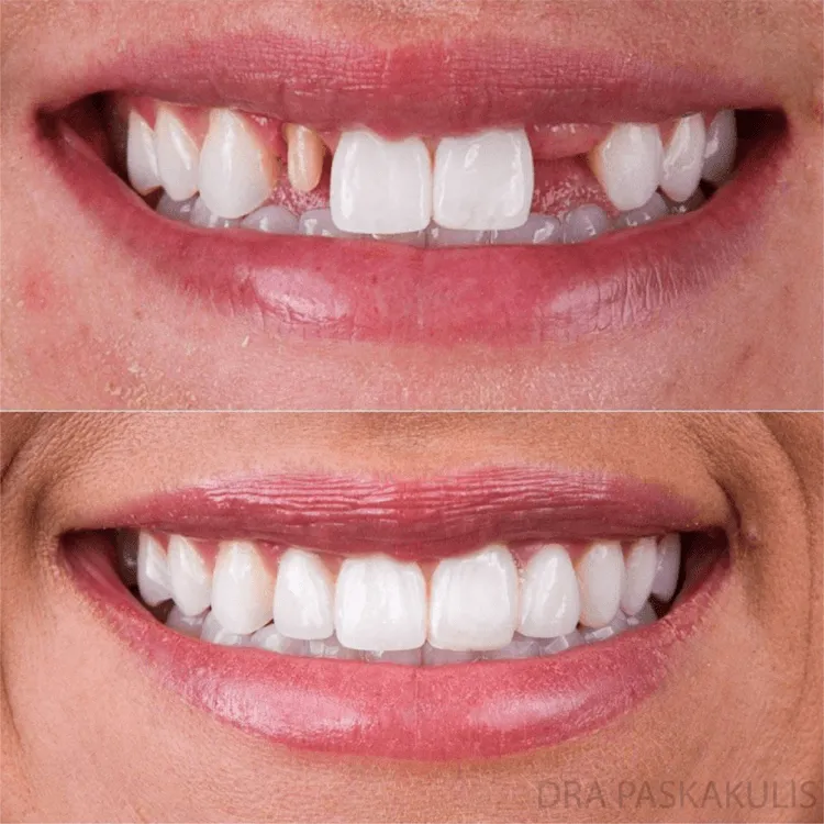 Antes e depois lentes de contato dental — Instituto Paskakulis Jundiaí