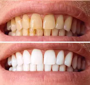 Finalização e Brilho Duradouro — Clareamento Dental
