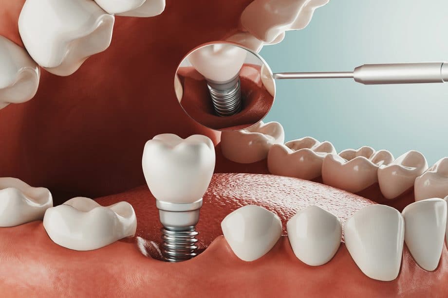 implante dentario em jundiai implante dentario em jundiai