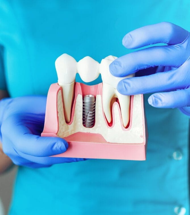 Implante dentário modelo. Implante dentário modelo.