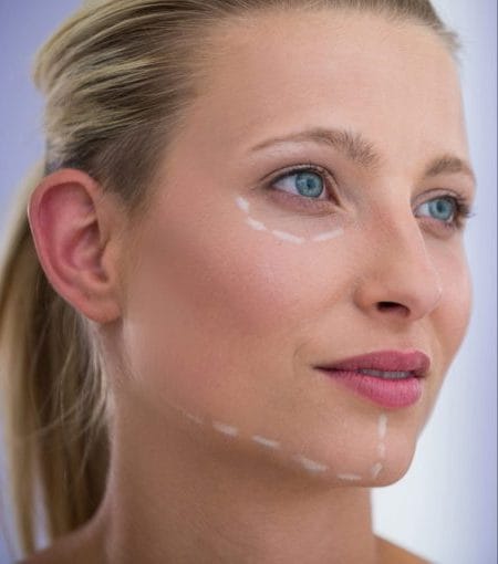 Preenchimento facial ácido hialurônico Preenchimento facial com ácido hialurônico