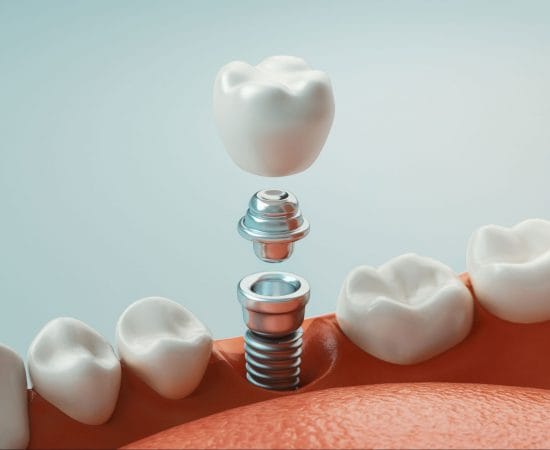 quanto custa implante dentario em Jundiai quanto custa implante dentario em Jundiai