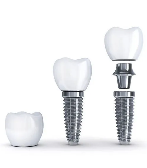 implante dentario implante dentario