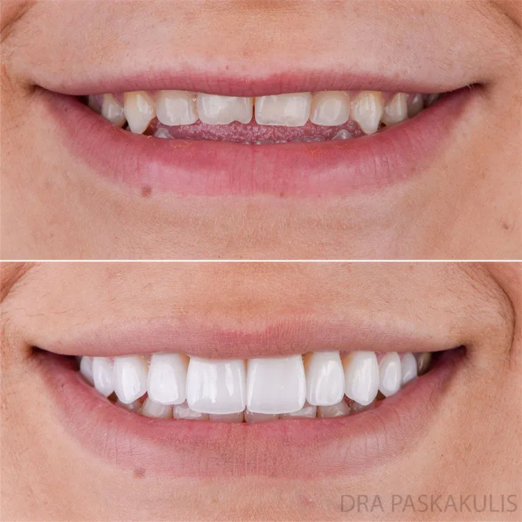 lente de contato dental antes depois lente de contato dental antes depois