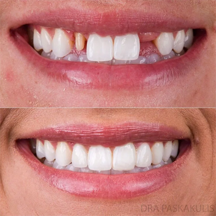 lente de contato dental antes depois lente de contato dental antes depois
