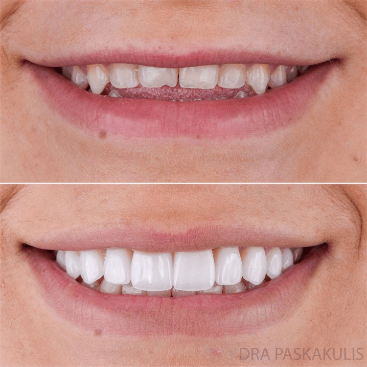 Faceta lente antes instituto paskakulis