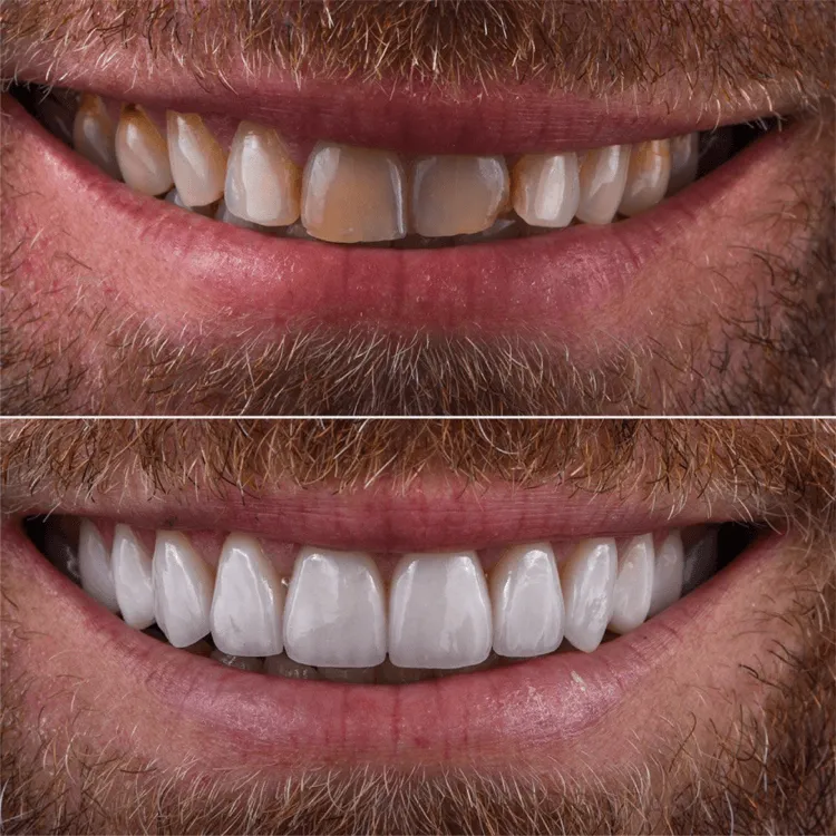 Lente de contato5 antes depois